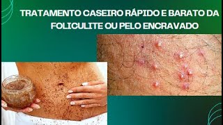 Foliculite tratamento rápido caseiro e eficiente [upl. by Tremann]