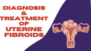 What Are The Treatments For Uterine Fibroids  How To Get Rid of Fibroids [upl. by Belia967]