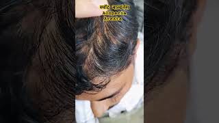 Alopecia Areata Spot Baldness hairfall [upl. by Leirvag]