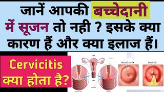 बच्चेदानी में सूजन क्यों होती है  क्या कारण और इलाज  Bacchedani mein Sujan  Cervicitis in hindi [upl. by Sylirama125]