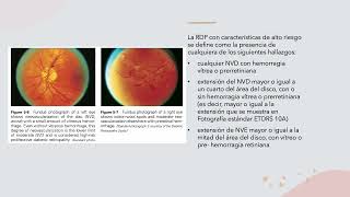 RETINOPATIA DIABETICA Y COREORETINOPATIA SEROSA CENTRAL [upl. by Eletnahs]