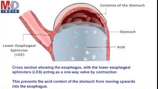 All About Reflux Esophagitis [upl. by Olivia]