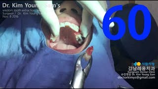 premolar extraction with forceps for orthodontic treatment [upl. by Allveta879]