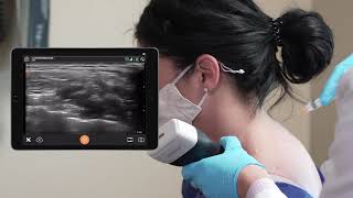 Supraclavicular Brachial Plexus Nerve Block  Ultrasound Scanning Technique [upl. by Zedecrem267]