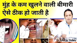 मुन्ह कम खुलने इलाज  Oral submucous fibrosis Causes and Treatment EXPERT ADVICE [upl. by Klepac]