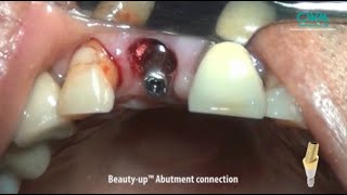 BGBRBMP Guided Bone Regeneration with Beautyup Abutment amp Natural Tooth [upl. by Ahseenal]