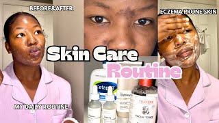 My Skin Care RoutineHow I Cleared My Eczema amp Hyperpigmentation skincareroutine blackgirlskincare [upl. by Aihsyla]