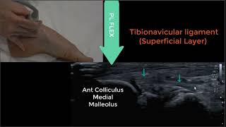 Deltoid Ligament Ultrasound 2023 [upl. by Skyla]