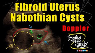 Fibroid Uterus with Nabothian Cysts  Ultrasound  Doppler  Case 267 [upl. by Stephenson757]