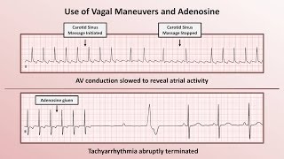 Intro to EKG Interpretation  How to Identify Any Tachyarrhythmia with 6 Easy Questions [upl. by Darelle]