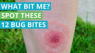 What Bit Me Spot These 12 Bug Bites [upl. by Atekahs]