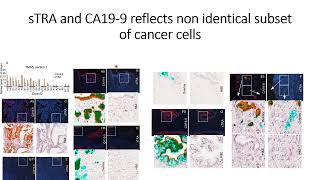 sTRA amp CA199 glycans express nonidentical subset of pancreatic cancer cell populations Code 695 [upl. by Cadmarr411]