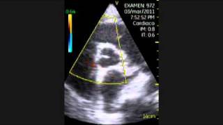 VSCAN Cardiomyopathy of Hypothyroidism Pocket ultrasound Cardiopatía en hipotiroidismo [upl. by Capwell460]