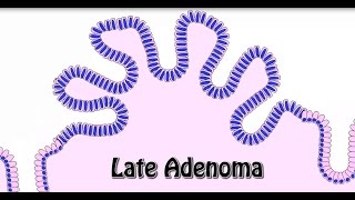 Animated Histology Colon Cancer Progression [upl. by Casey]