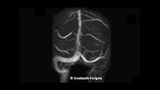 Hypoplastic Left Transverse sinus  MRV [upl. by Llevert]