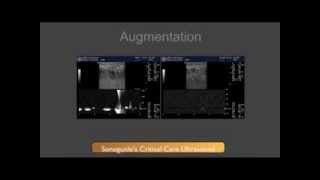 DVT Ultrasound Augmentation Technique [upl. by Azil]