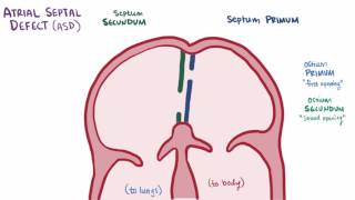 Atrial septal defect ASD repair causes types symptoms amp pathology [upl. by Tiffany]