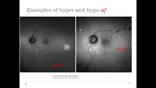 Best practices for utilizing FAF amp UWF retinal imaging in the optometric practice [upl. by Shirline]