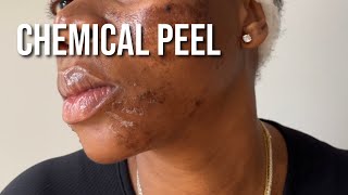 PCA Chemical Peel on Black Skin for Hyperpigmentation and Texture [upl. by Cohe]