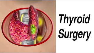 Thyroid Surgery to Remove Nodule Suspicious for Cancer [upl. by Lletram]