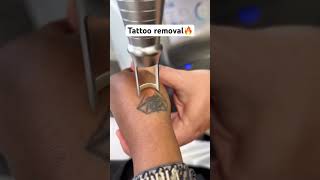 tattoo removal woahh😱 [upl. by Eeroc768]