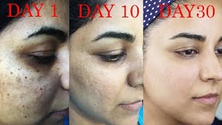 How I Got Rid of Dark Scars Hyperpigmentation PimplesAcne [upl. by Thormora]