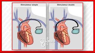 pleuropéricardite après implantation dun stimulateur cardiaque [upl. by Loftis]