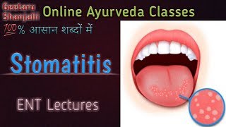 Stomatitis मुखपाक by geetaru [upl. by Notrab]