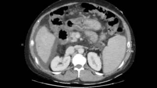 portal enteropathy [upl. by Kancler]