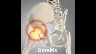 Osteitis inflammation of boneshorts [upl. by Grevera]