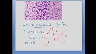 Adenoid Cystic Carcinoma Final 2024 [upl. by Edithe]