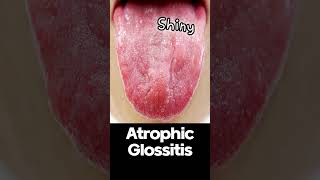 Atrophic Glossitis  Symptoms and Causes shorts [upl. by Mariken]