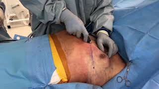 GYNECOMASTIA TREATMENT  Procedure overview and video [upl. by Mathia]