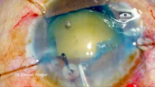 Capsule Tension Ring CTR part 3 final CTR in SICS case Dr Deepak Megur [upl. by Eybba]