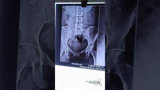 X ray of pelvis👨‍⚕️BAMS students  NEET ayurveda bams mbbs internship [upl. by Sainana]