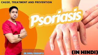 Psoriasis kya hai Types Causes Diagnostic Treatment and prevention Suroj Mahanta psoriasis [upl. by Affrica]