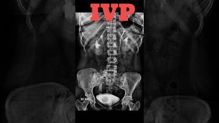 IVP  Intravenous pyelography shorts ivp specialcase radiology radiologyjunction [upl. by Binnie]