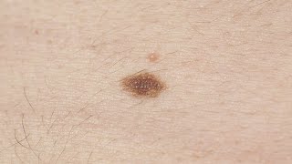 Melanoma symptoms How to spot signs and when to see a doctor [upl. by Arihay476]