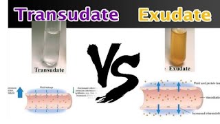 Transudate and Exudate pathology transudate Vs ExudateEasy to understand pathology [upl. by Maurreen]