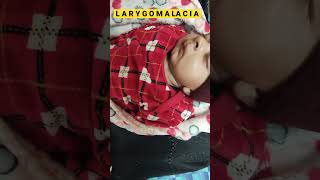 Laryngomalacia laryngomalacia noisy breathing chest [upl. by Weig]