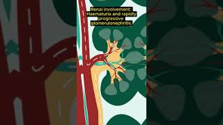 MRCP Exam tip CGPA vs EGPAGranulomatosis with polyangiitis [upl. by Nethsa]