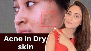 Acne in Dry Skin  what to use  serums creams  Dermatologist recommends [upl. by Gereld]