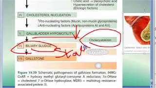 Pathology 641 c Pathogenesis of GallStones Cholelithiasis Gall Bladder Stones Cholecystokinin [upl. by Abrahams]