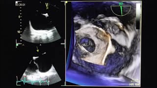 Atrial septal defect ASD II with left toright shunt [upl. by Adihsar809]