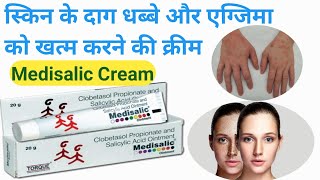 Medisalic ointment  Medicine cream use in Hindi  गोरेपन की क्रीम मेडिसेलिक क्रीम के फायदे [upl. by Eiramassenav]