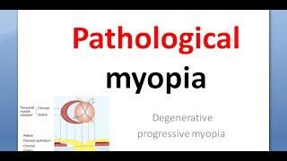 Ophthalmology Pathological myopia crescent Foster Fuchs spot lattice posterior staphyloma atropine [upl. by Esoryram658]