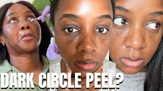 TCA Chemical Peel on Black Skin Before and After Dark Circles [upl. by Ailis258]