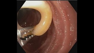 Ascariasis Removal from papilla BDENDOSCOPY [upl. by Lladnar]