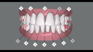 Alignment and intrusion of anterior teeth of an adult patient invisalign clincheck simulation [upl. by Towrey60]