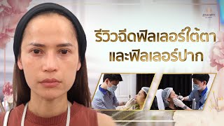 🚩 รีวิวฉีดฟิลเลอร์ใต้ตา และฟิลเลอร์ปาก [upl. by Meijer]